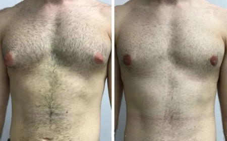Why Men Are Opting for Gynecomastia in Dubai More Than Ever