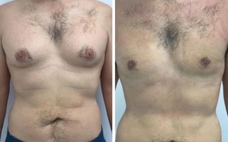 The Importance of Early Treatment for Gynecomastia in Dubai