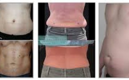 A Complete Guide to Liposuction Fat Removal Treatment: What to Expect