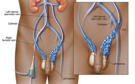 Best Varicocele Treatments for Pain Relief and Fertility Boost