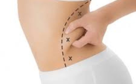 Liposuction in Islamabad – Transform Your Body with Confidence