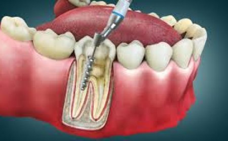 Root Canal Treatment Cost: What to Expect and How to Budget